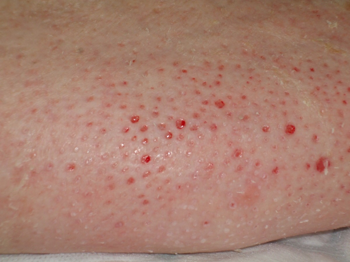 hard tiny balls under skin pits hard tiny balls under skin pits