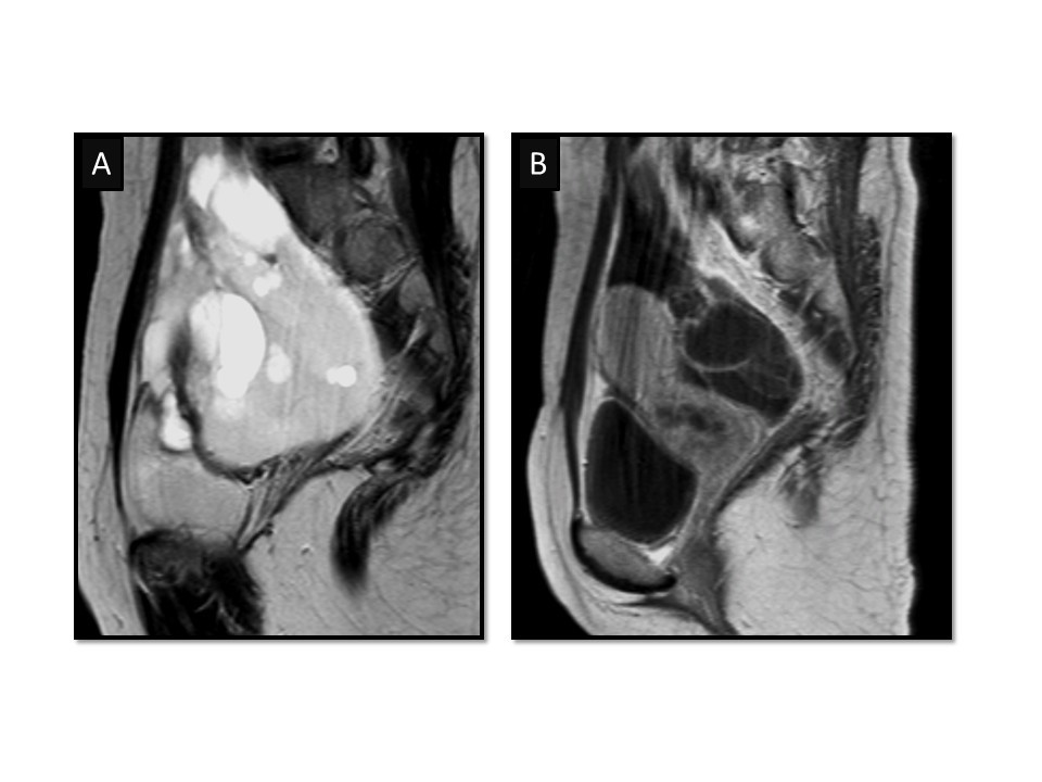 Benign multicystic peritoneal mesothelioma mimicking recurrence of an