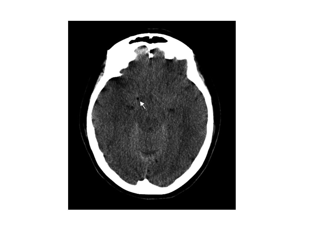 Subdural spread of injected local anesthetic in a selective