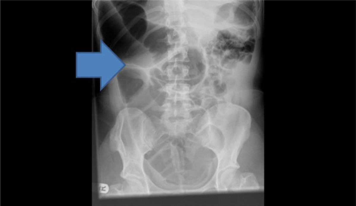 Colopexy as a treatment option for the management of acute transverse