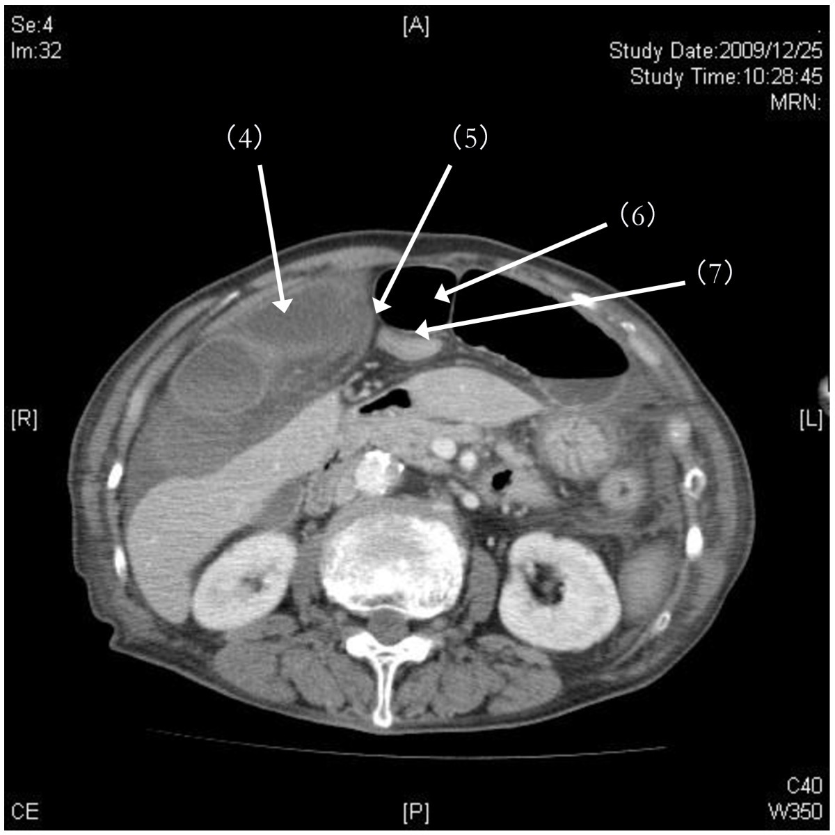 Pre-operative diagnosis and successful surgery of a strangulated