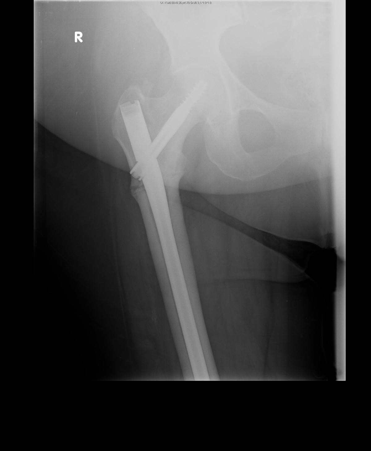 Spontaneous transverse subtrochanteric femoral fracture with