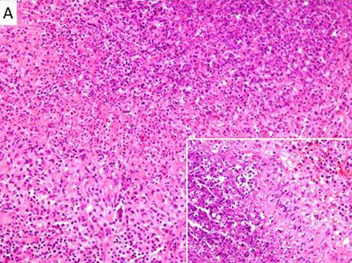 Suppurative necrotizing granulomatous lymphadenitis in adultonset