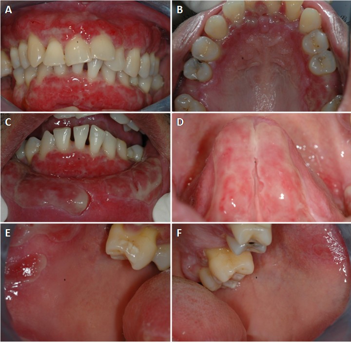 Mucous membrane pemphigoid in a patient with hypertension treated with