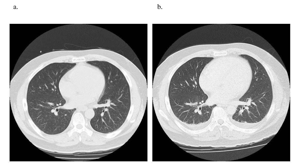 Pneumococcal polyarticular septic arthritis after a single infusion of