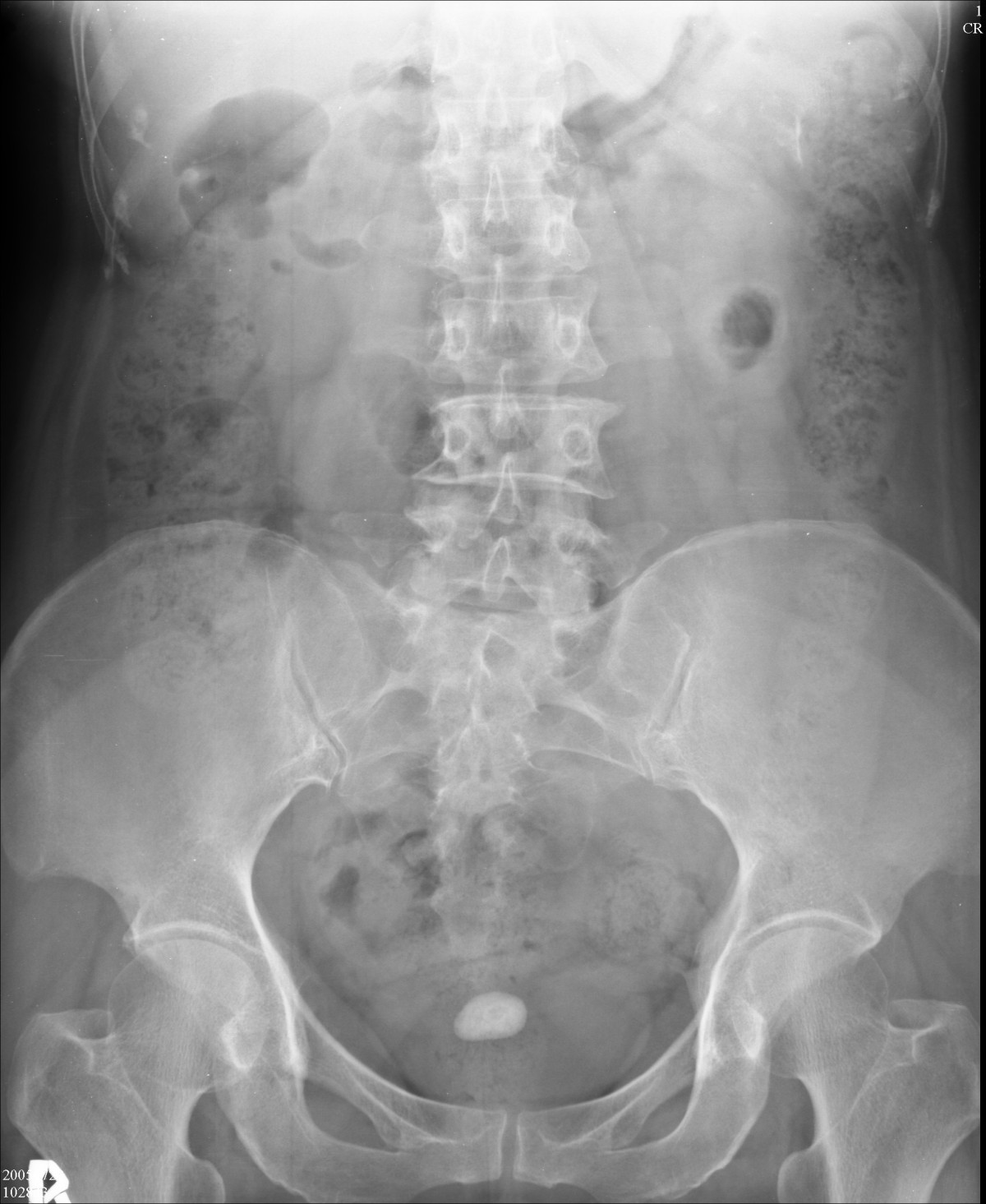 Intravesical stone formation several years after hysterectomy: a case