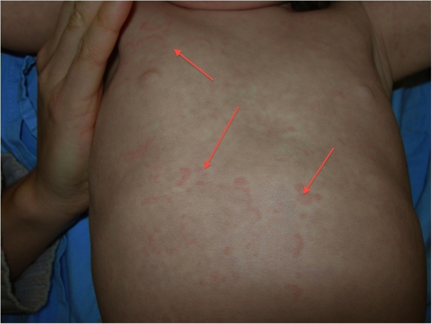 A child with autoimmune polyendocrinopathy candidiasis and 