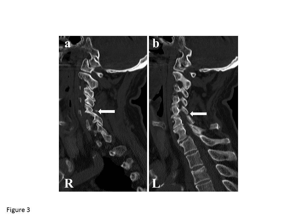 Delayed surgical treatment for a traumatic bilateral cervical facet