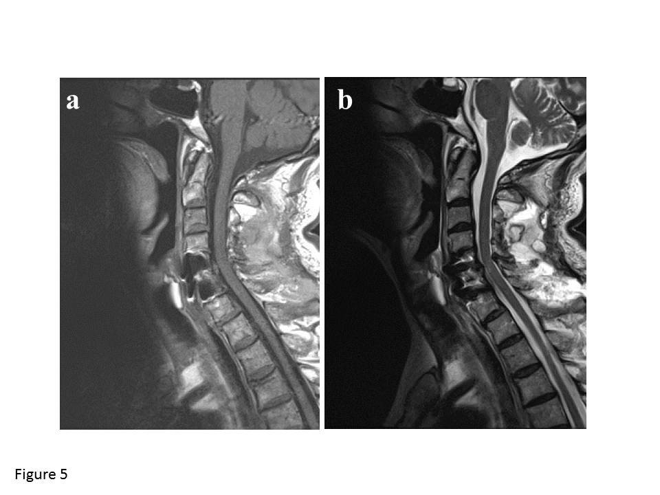 Delayed surgical treatment for a traumatic bilateral cervical facet