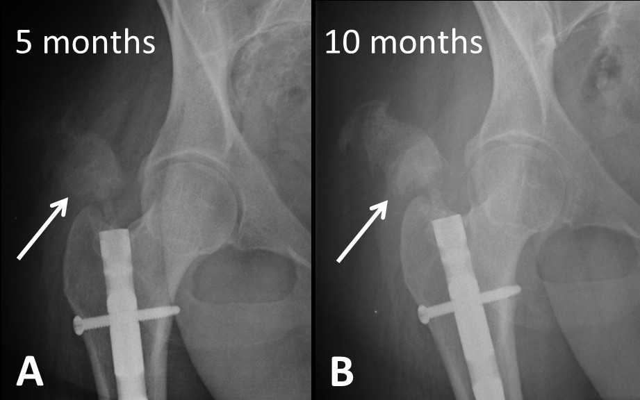 Heterotopic ossification in the reaming tract of a percutaneous