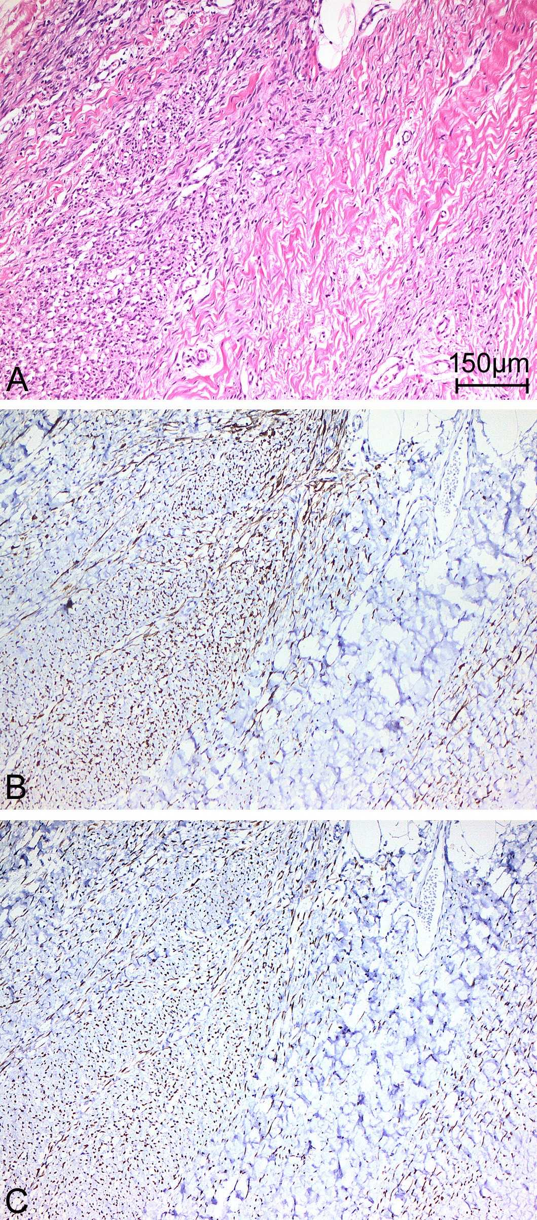 An adult spindle cell in the head and neck region with