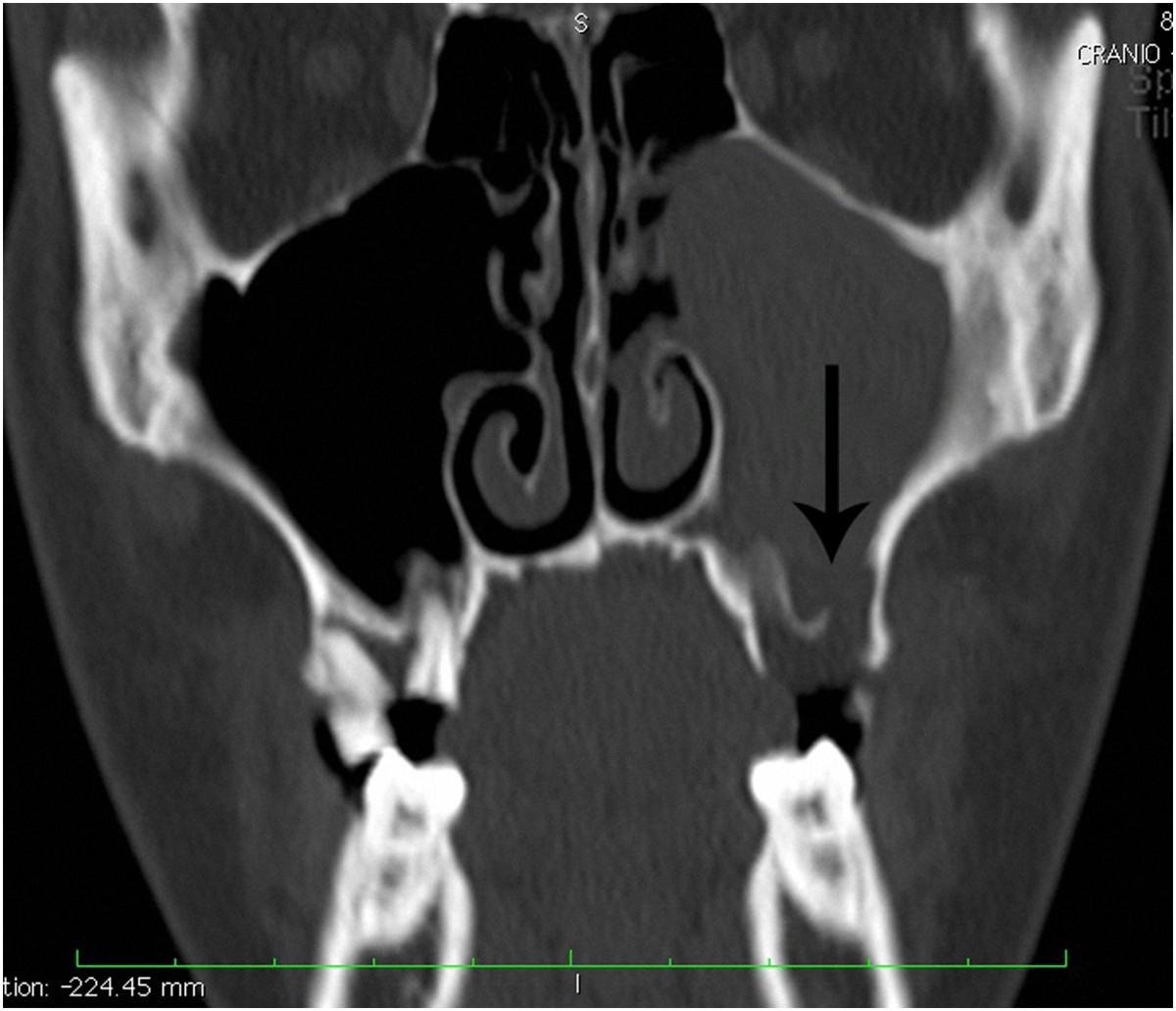 Parietal subdural empyema as complication of acute odontogenic ...