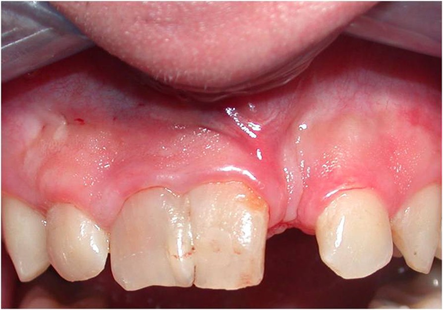 Multidisciplinary approach to fused maxillary central incisors a case