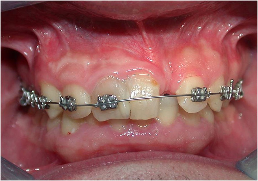 Multidisciplinary approach to fused maxillary central incisors a case