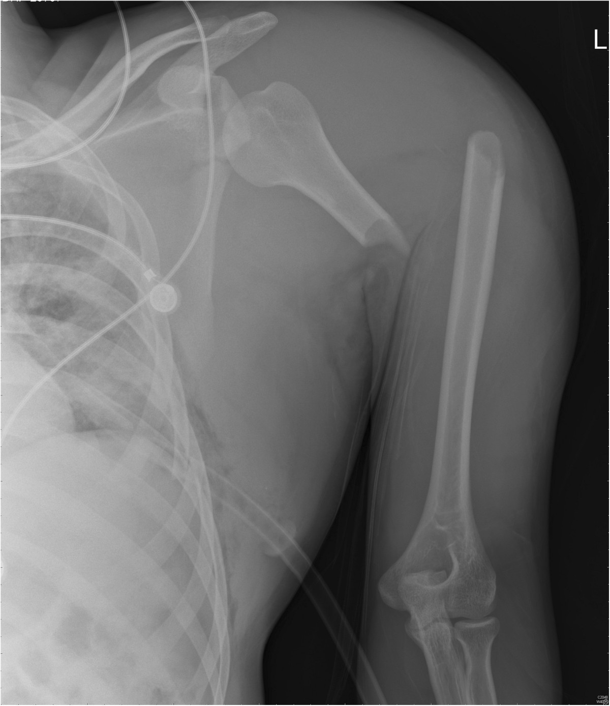 Mechanism of injury and management in traumatic anterior shoulder