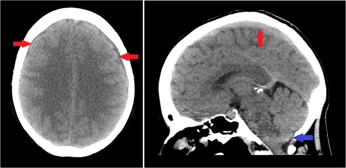 Spontaneous cerebrospinal fluid leak following a pilates ...