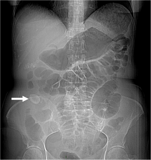 Case Study for Abdominal Obstruction