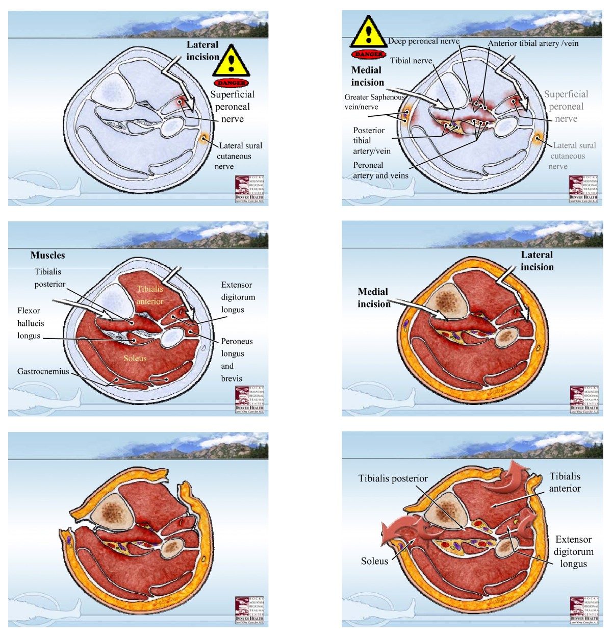 Lower extremity compartment syndrome in the acute care surgery paradigm