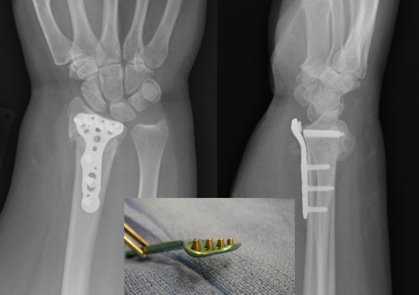 Failure of volar locking plate fixation of an extraarticular distal