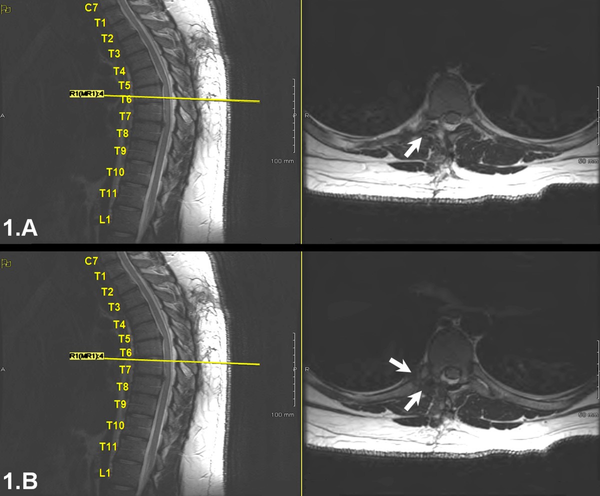 Unusual spine anatomy contributing to wrong level spine surgery: a case