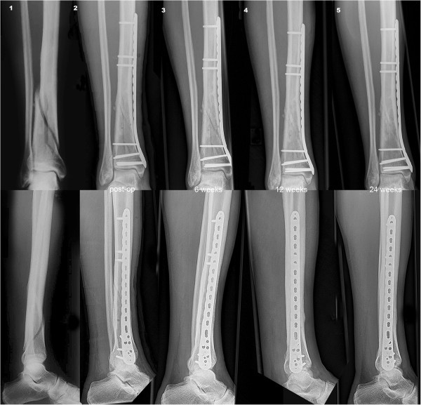 Controlled dynamic stability as the next step in “biologic plate