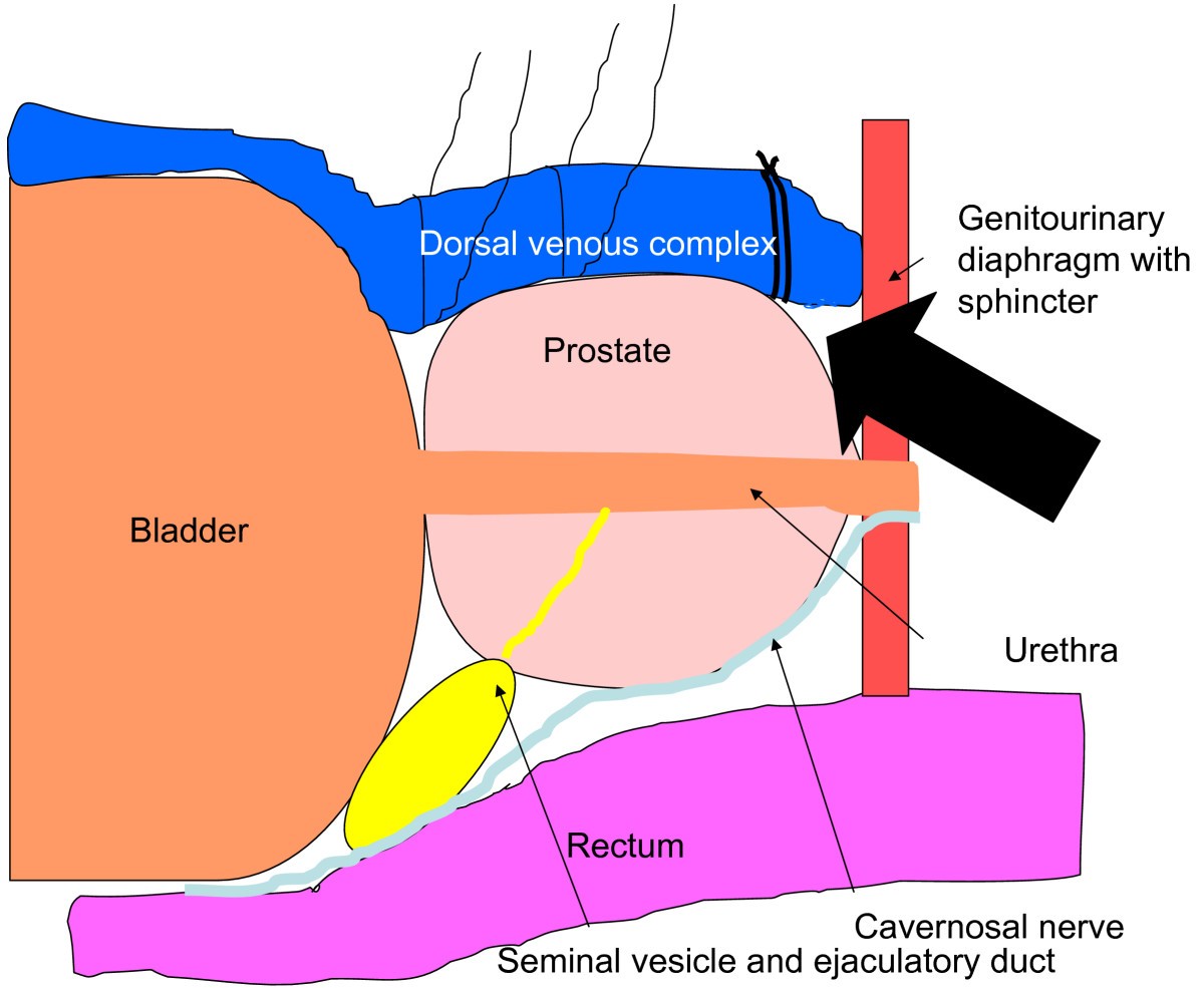 Blunt apical dissection during anatomic radical retropubic