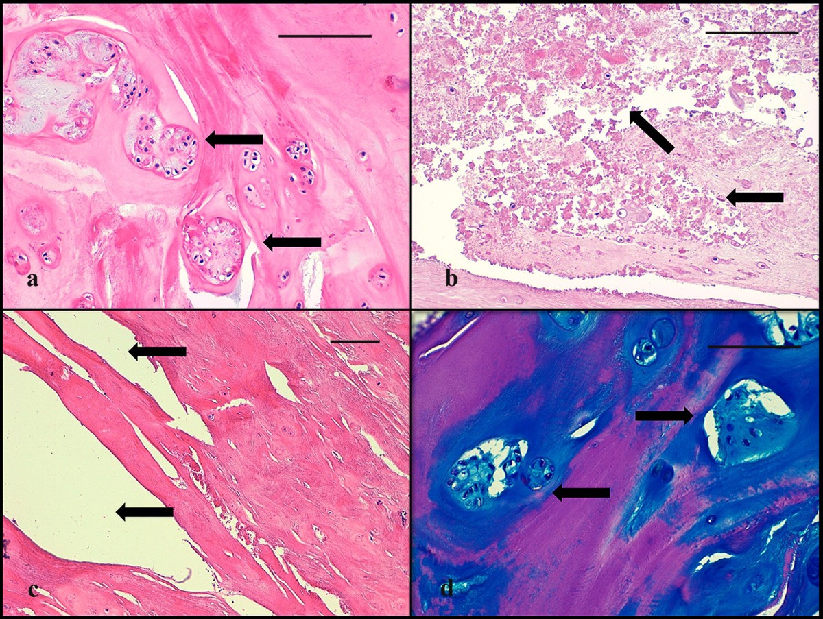 Histological analysis of surgical lumbar intervertebral disc tissue