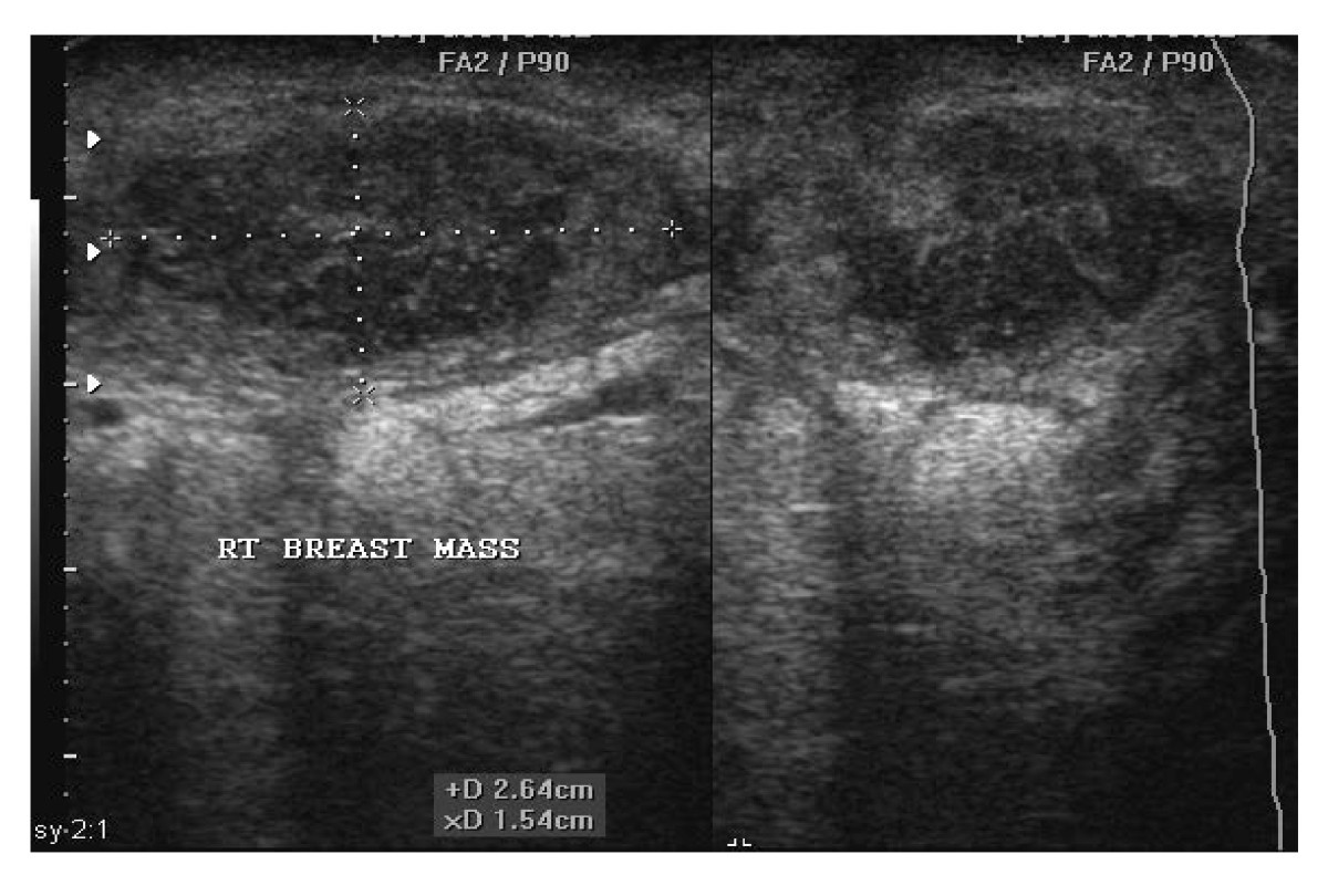 Ultrasound Guided Needle Aspiration versus Surgical Drainage in the