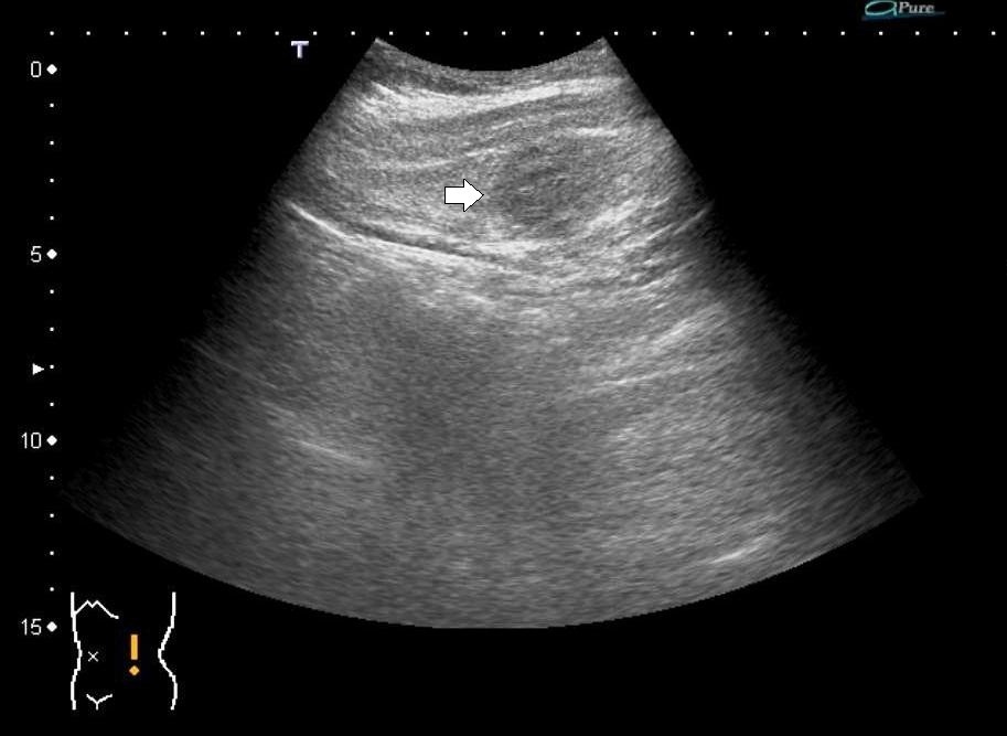 An oblique muscle hematoma as a rare cause of severe abdominal pain: a
