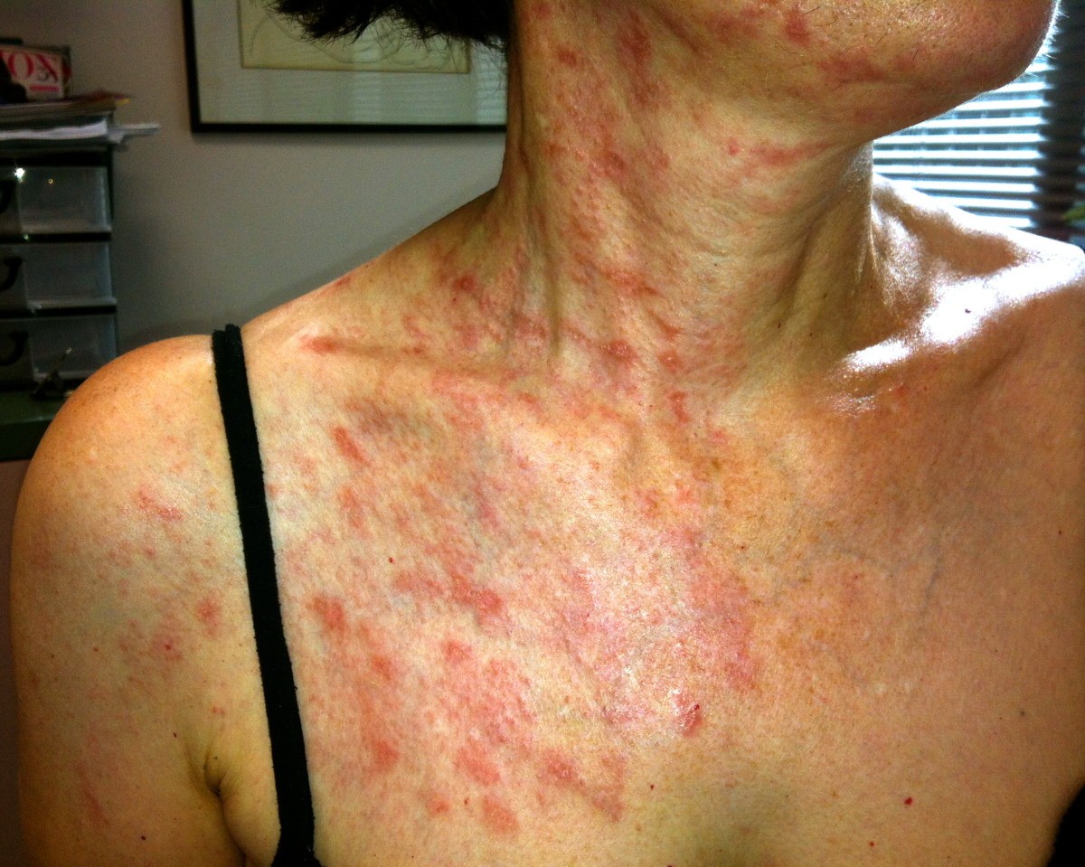 An unexpected case of Ramsay hunt syndrome: case report and literature