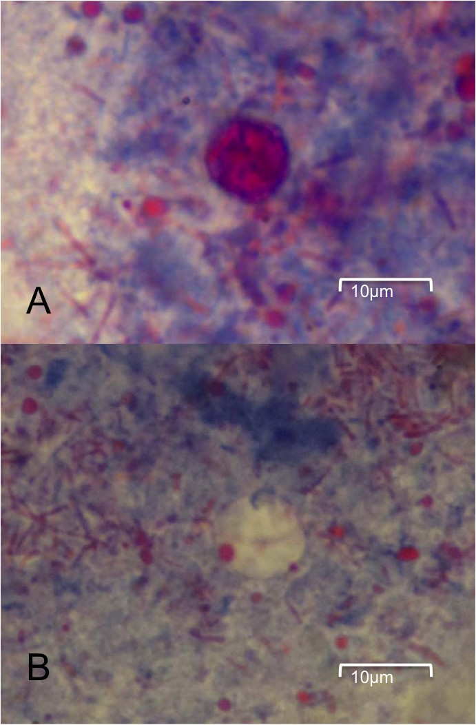 Cyclospora infection in a young woman with human immunodeficiency virus in Hong Kong a case