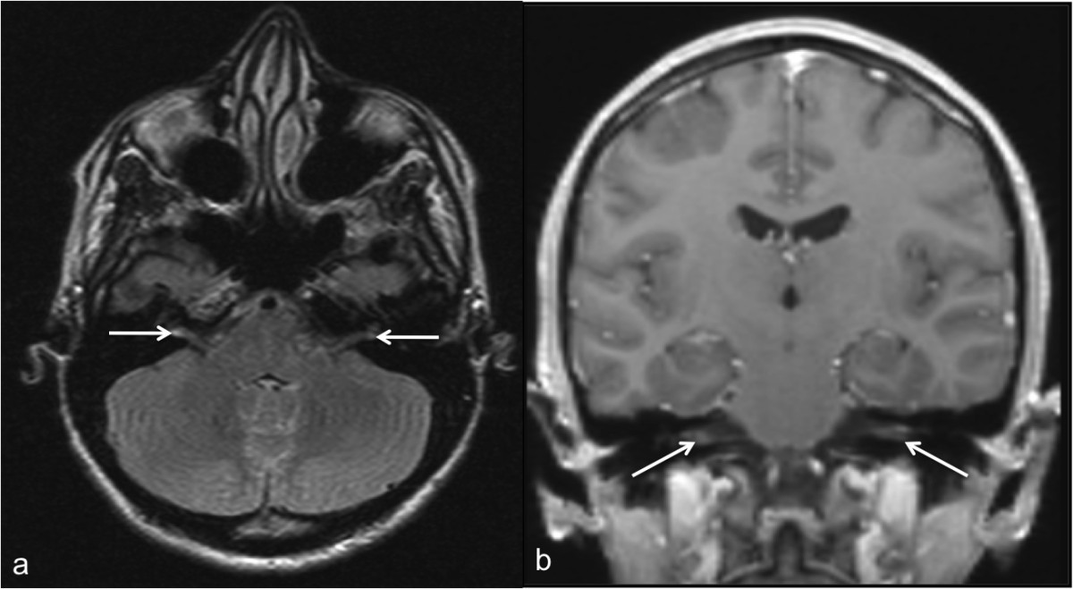 Brainstem Abnormalities And Vestibular Nerve Enhancement In Acute