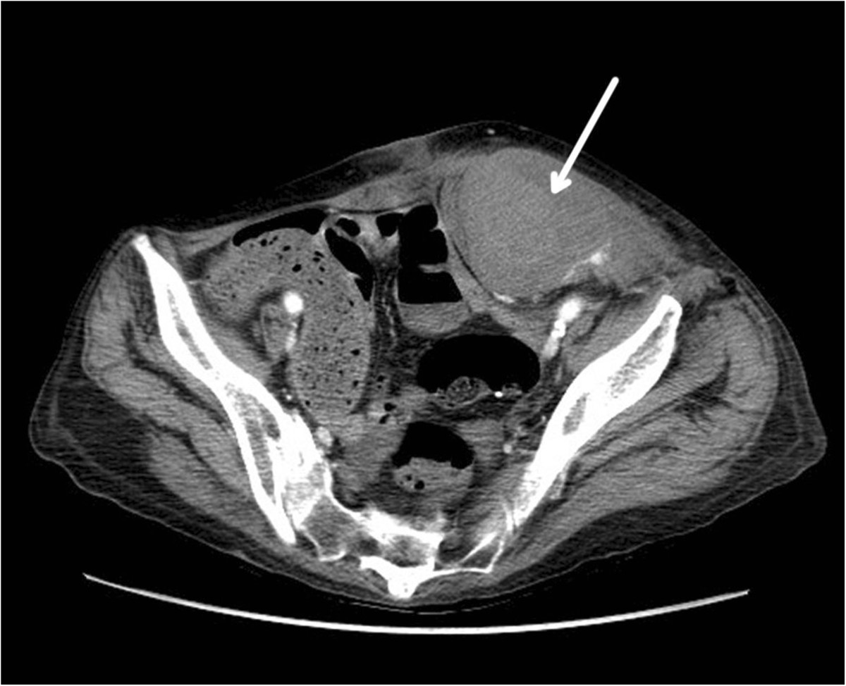 Rectus sheath hematoma with low molecular weight heparin ...
