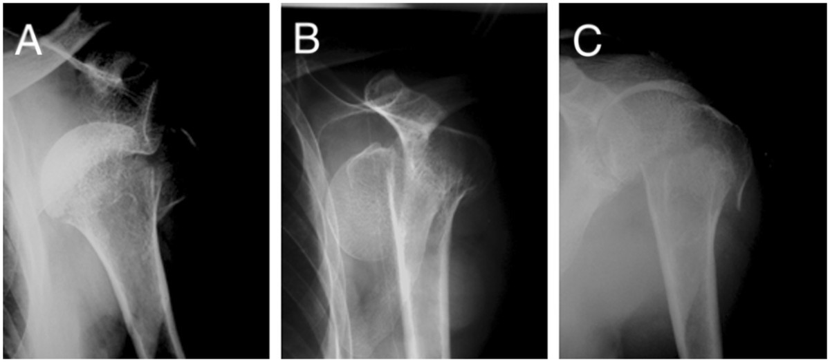 Successful closed reduction for iatrogenic displacement of the ...