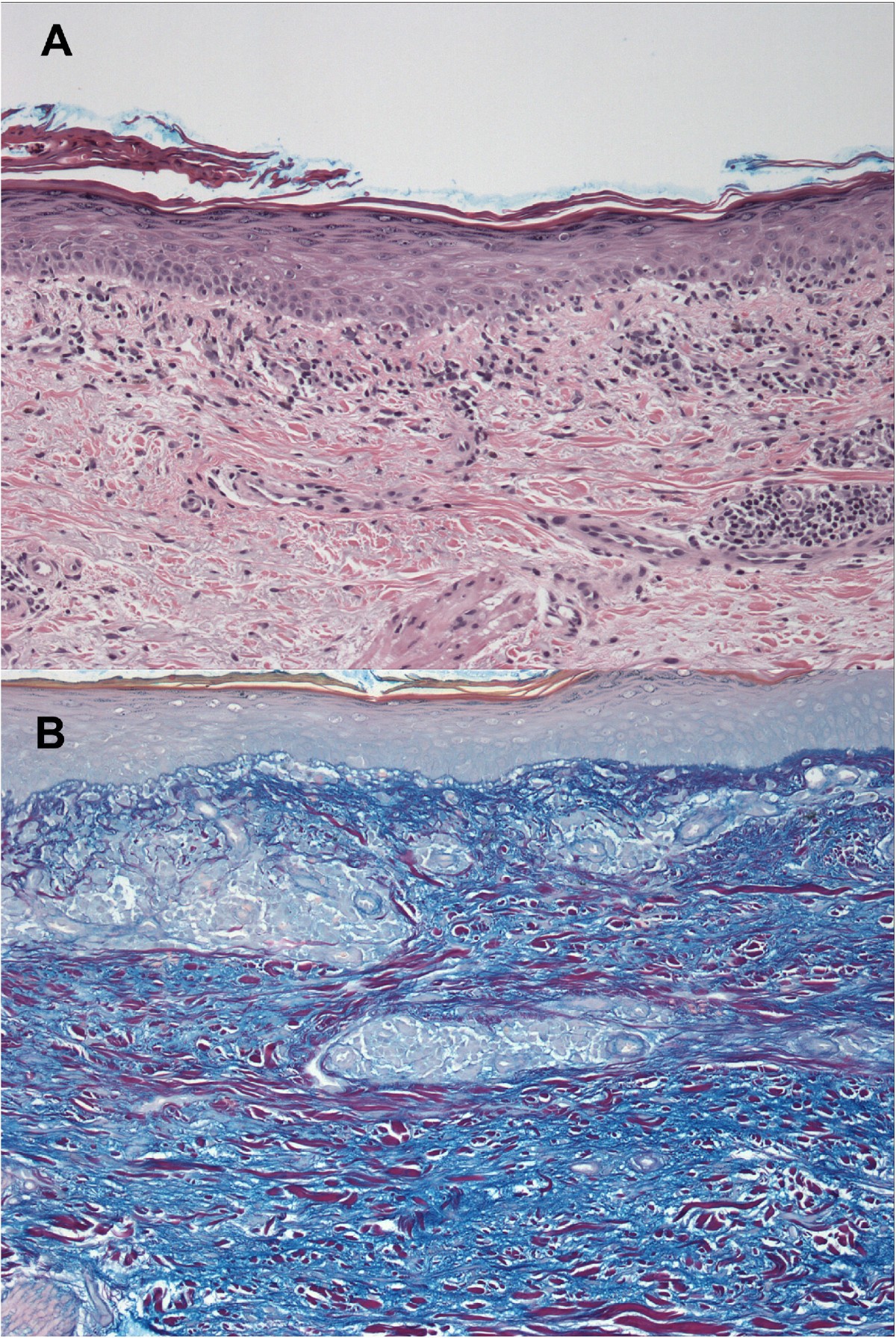 Druginduced subacute cutaneous lupus erythematosus associated with