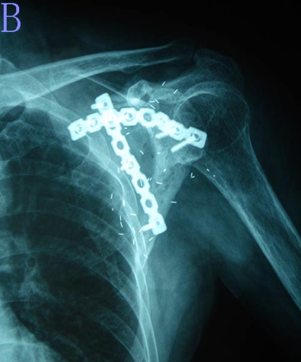 Surgical technique and clinical results for scapular allograft