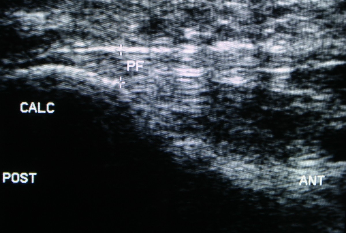 Ultrasound guided injection of dexamethasone versus placebo for