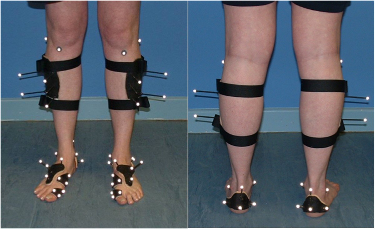 Foot kinematics in patients with two patterns of pathological plantar