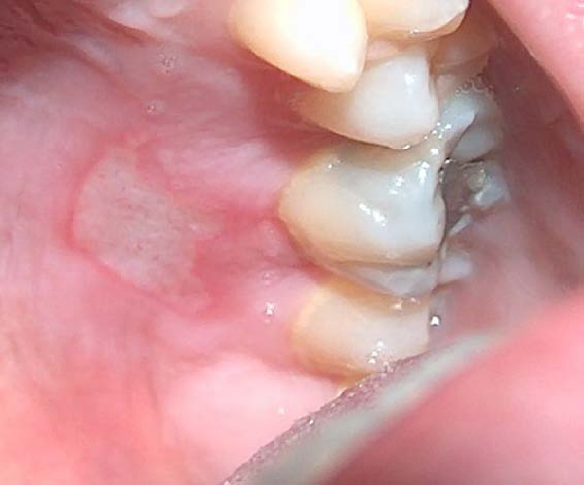 Thermal burn of palate caused by microwave heated cheesepie A case