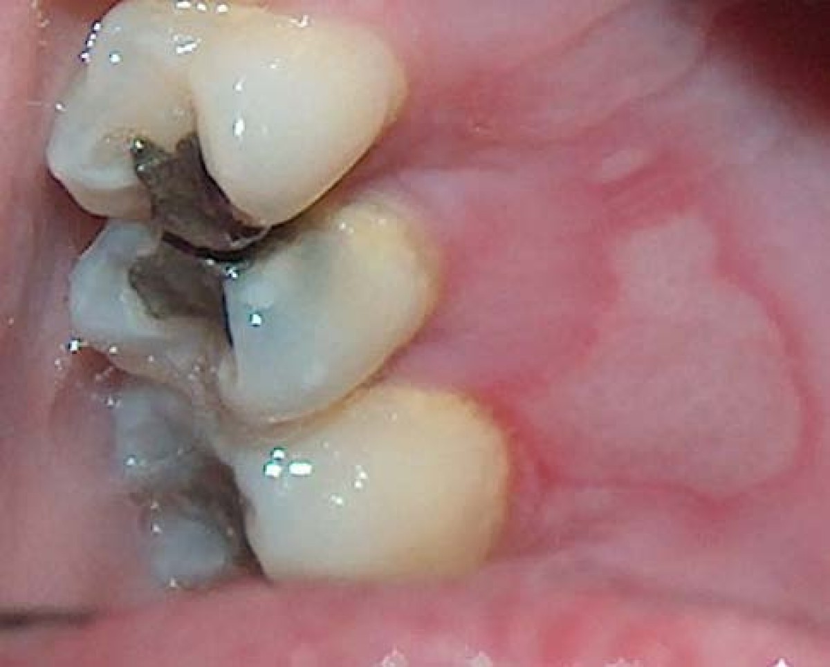 Thermal burn of palate caused by microwave heated cheesepie A case report Cases Journal