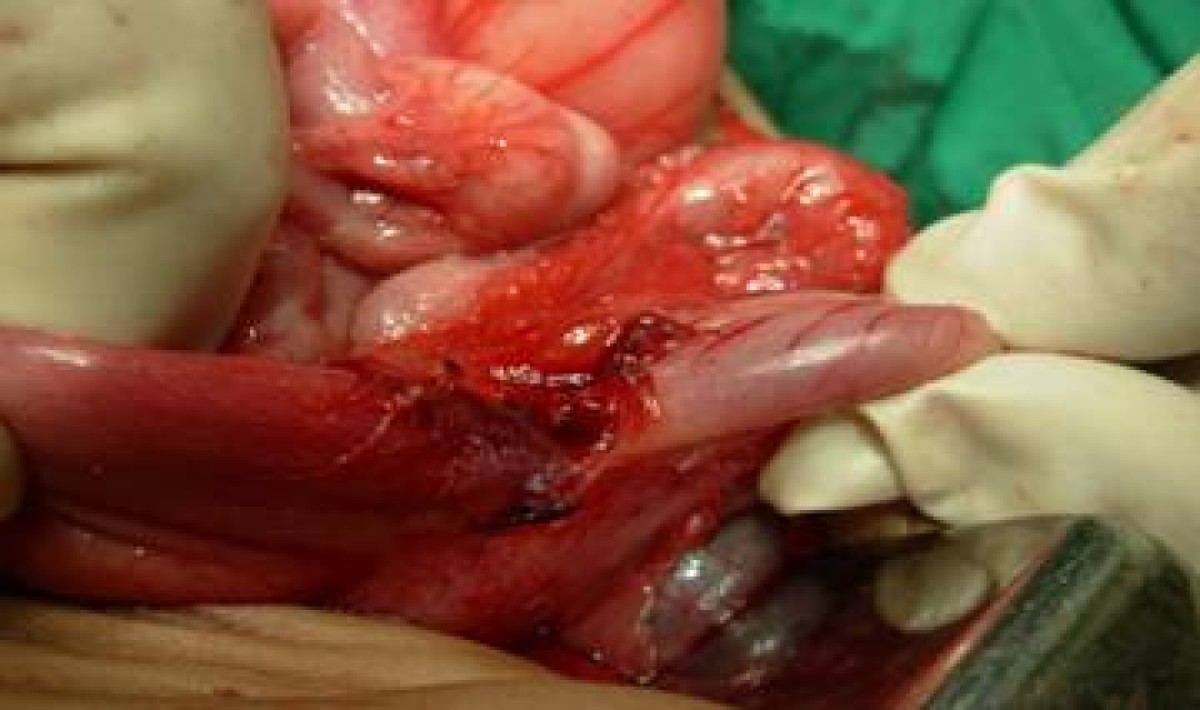 Unusual acquired gastric outlet obstruction during infancy: a case