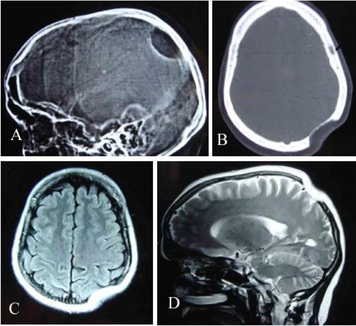 Gorham's disease involving the left parietal bone: a case report