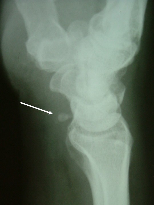 Anatomical variation of co-existence of 4th and 5thshort metacarpal