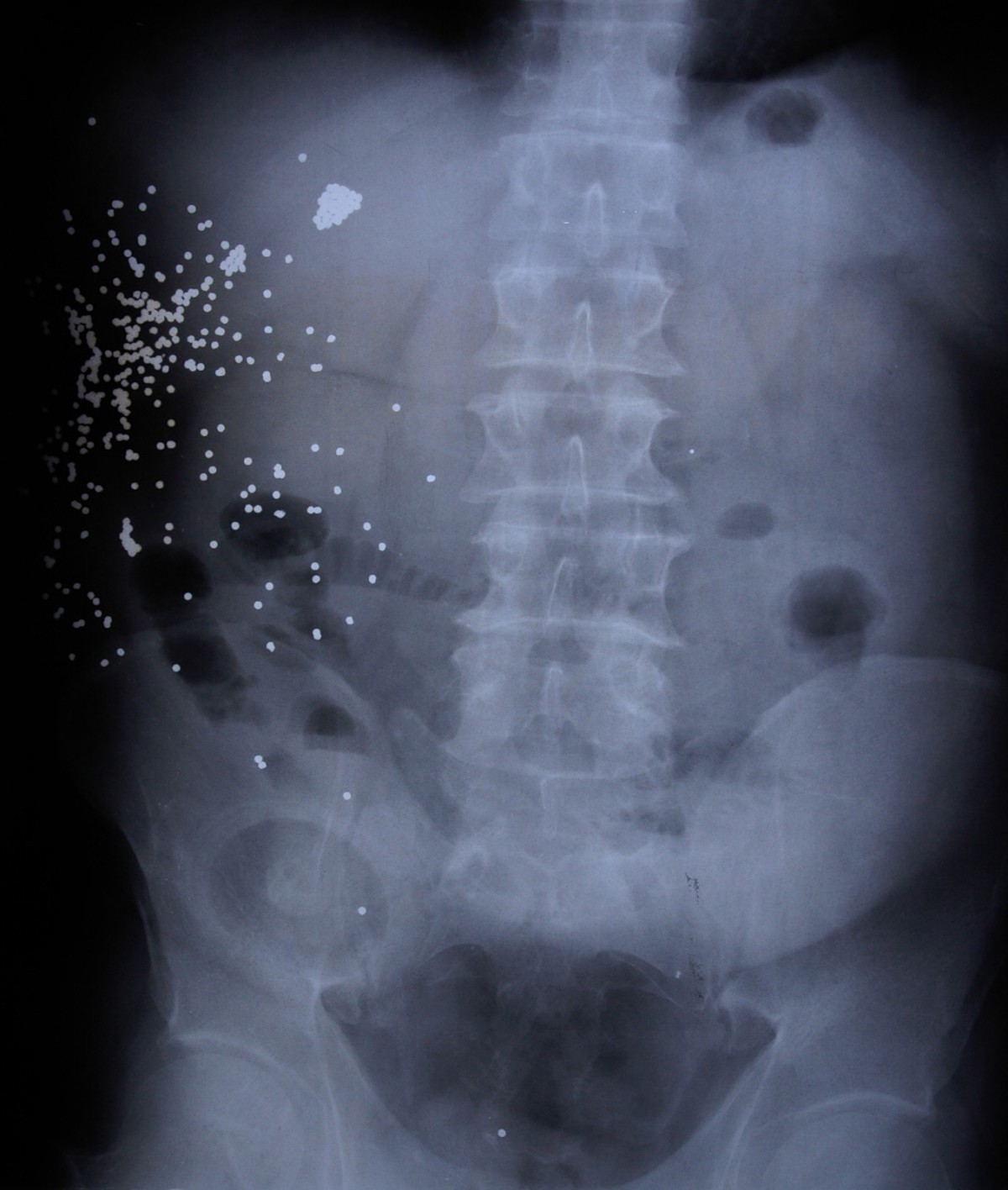 Abdominal shotgun trauma A case report Cases Journal Full Text