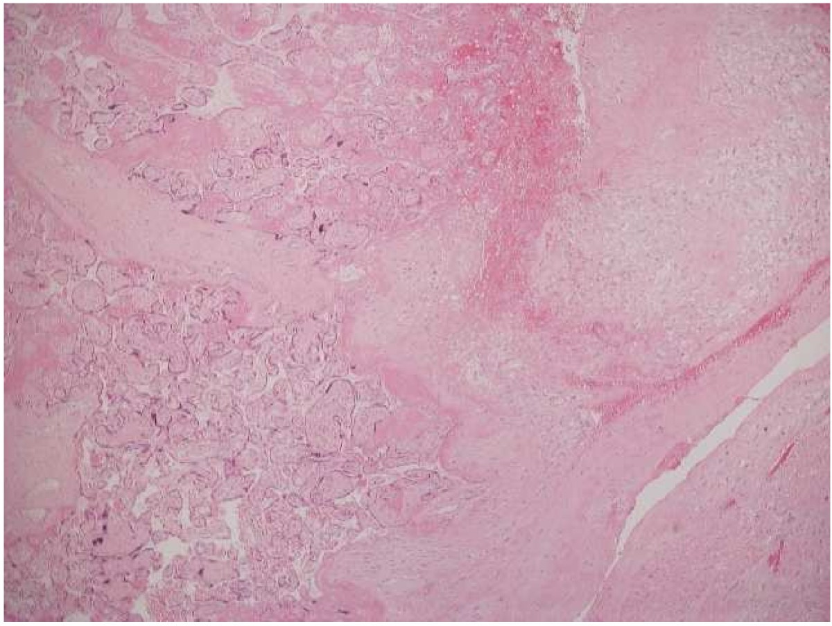 Post partum haemorrhage secondary to uterine atony, complicated by