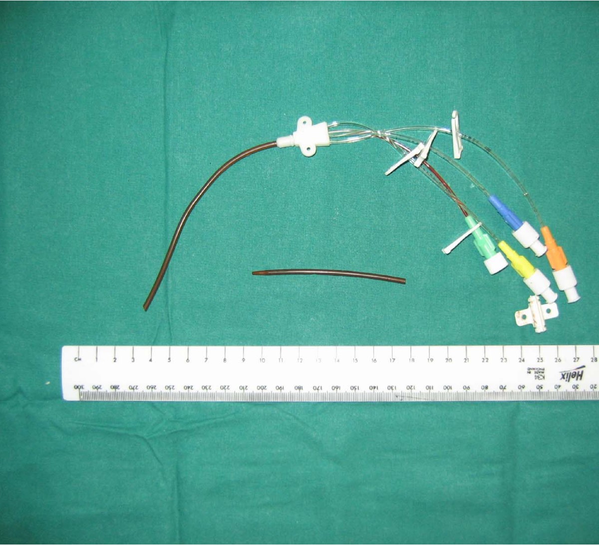 Traumatic fracture of central venous catheter resulting in potential