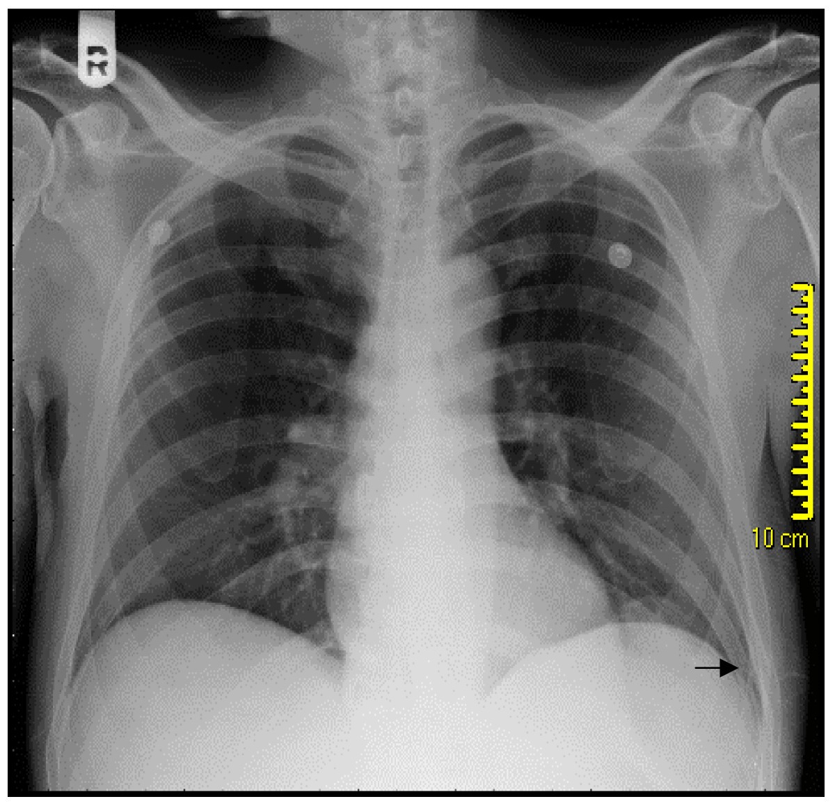 Locked lung by looped hernia: a case report | Cases Journal | Full Text
