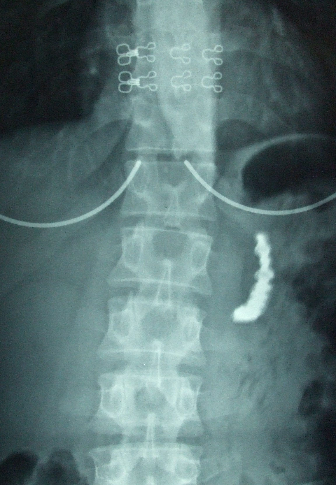 Accidental swallowing of partial denture a case report Cases Journal
