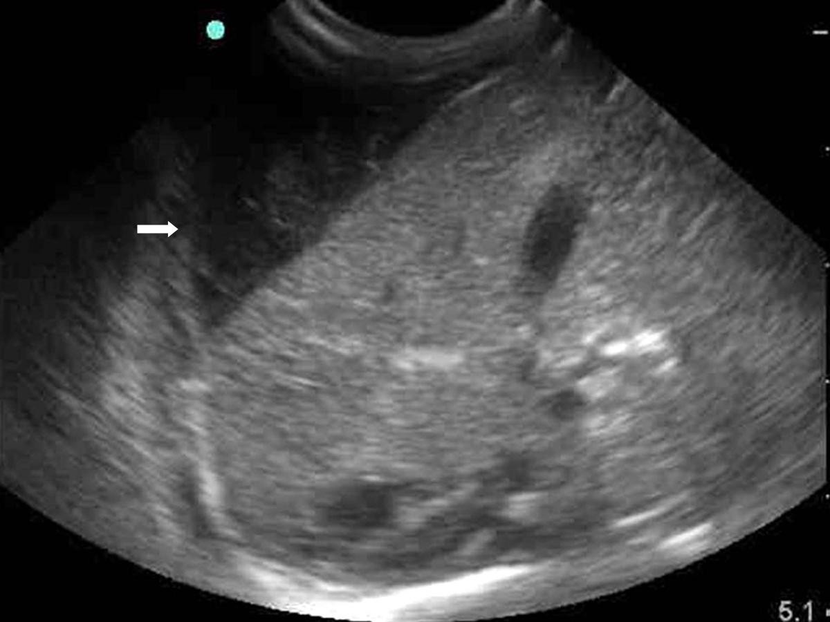 An incidentally detected hepatic subcapsular hematoma in a very low