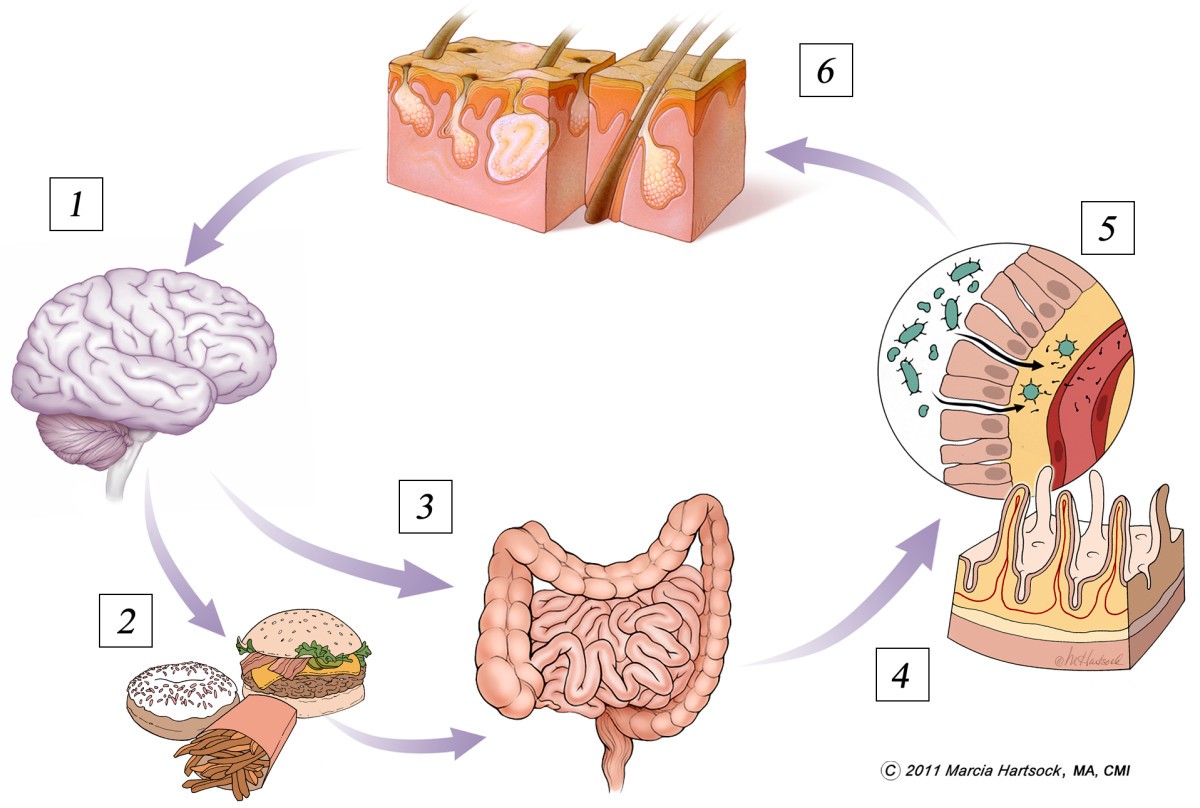 Acne vulgaris, probiotics and the gut-brain-skin axis ...